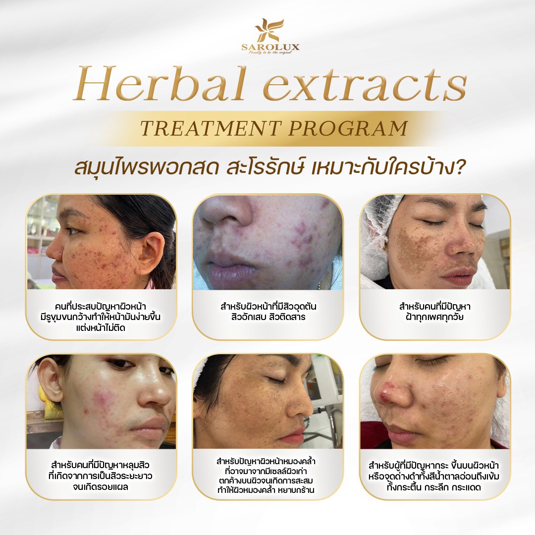 Herbal Extracts Treatment Program สมุนไพรพอกสด สะโรรักษ์เหมาะกับใครบ้าง ?