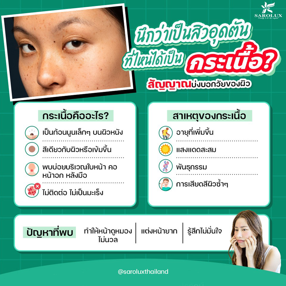 นึกว่าเป็นสิวอุตตันที่ไหนได้เป็น กระเนื้อ สัญญาบ่งบอกวัยของผิว