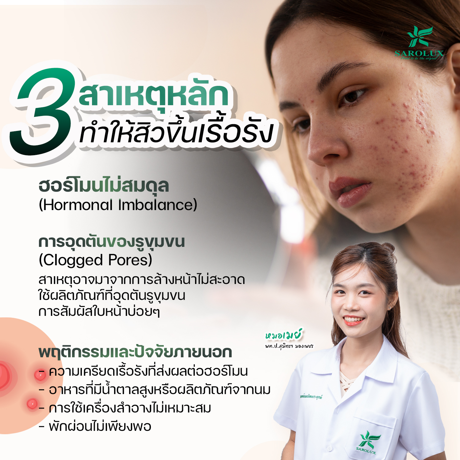 เปิด 3 สาเหตุหลักที่ทำให้เกิดสิวขึ้นเรื้อรัง ไม่หายสักที