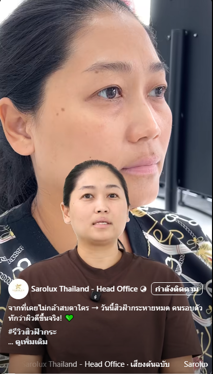 ริวิวลูกค้ามาทำหน้าสิวฝ้ากระหายศูนย์สะโรรักษ์