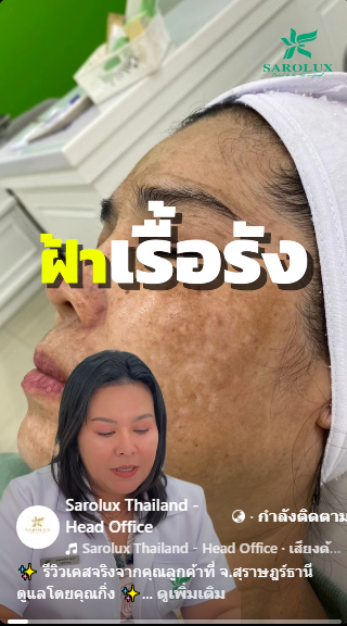 รีวิวลูกค้าเป็นฝ้าเรื้อรัง