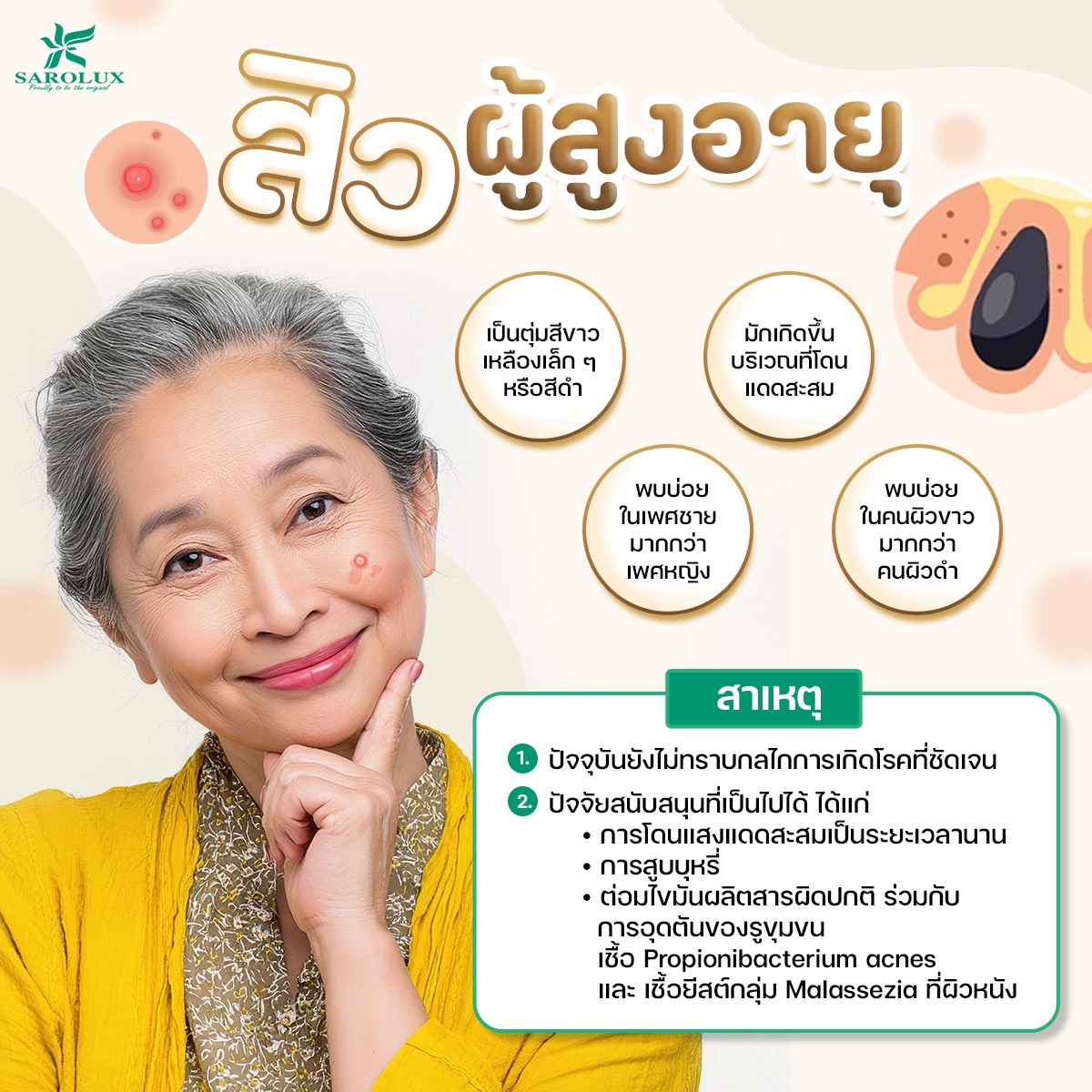 สิวผู้สูงอายุ