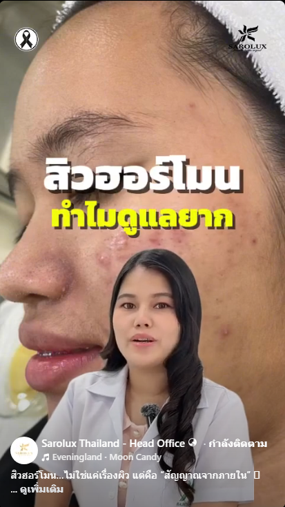 สิวฮอร์โมนทำไมดูแลยาก