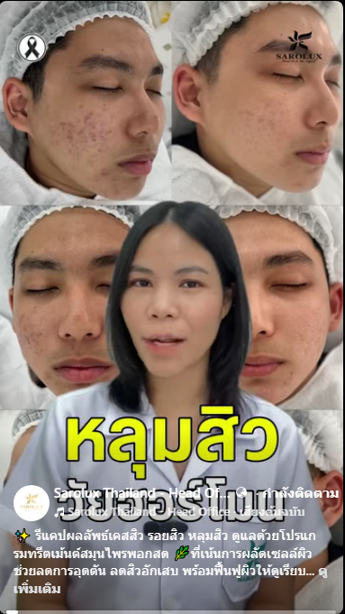 หลุมสิววัยฮอร์โมน
