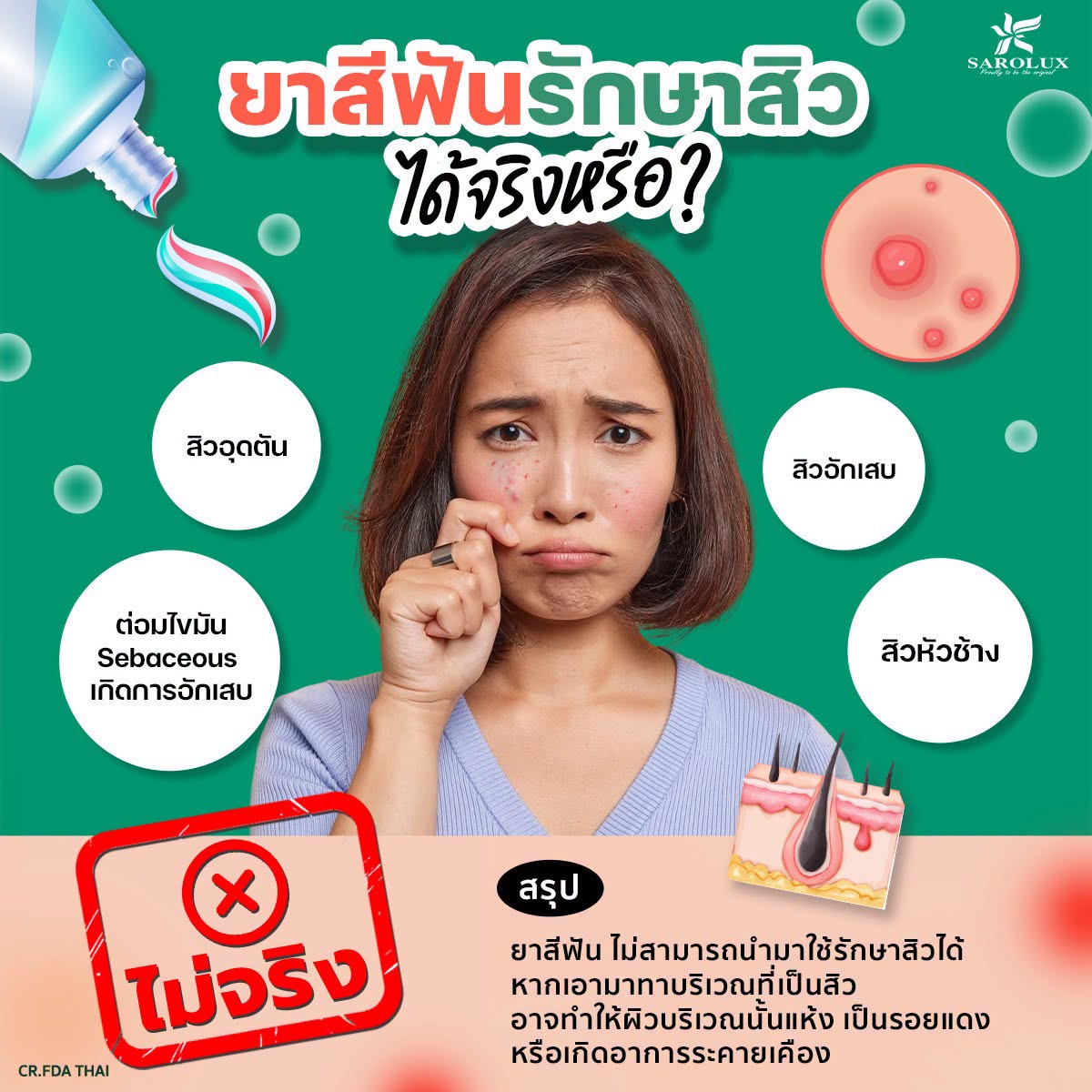 ยาสีฟันรักษาสิวได้จริงไหม?